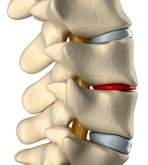 Bizkarrezurreko torakoaren osteochondrosia
