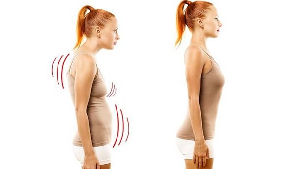 bizkarra zuzena eta postura txarra zerbikaleko osteokondrosiarekin